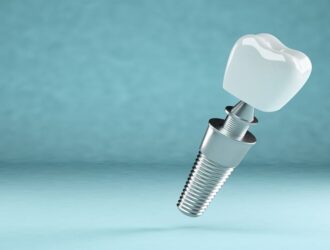 hechos y mitos sobre los implantes dentales