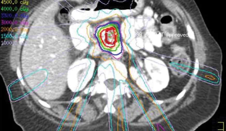 la radioterapia estereotáctica ralentiza la progresión del cáncer de páncreas en pacientes inoperables