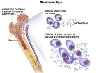 los científicos combinan agentes dirigidos para eliminar las células de mieloma múltiple