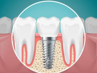 los implantes dentales en sydney lo que implica publicado el procedimiento por isabel rucker