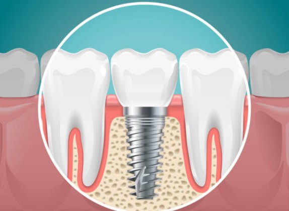 los implantes dentales en sydney lo que implica publicado el procedimiento por isabel rucker