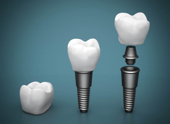 principales tipos de implantes dentales y sus beneficios
